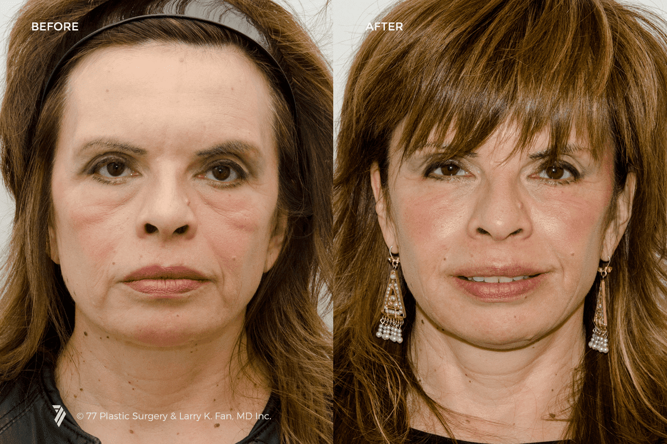 77plastic-Juvederm-Injectable-Fillers-1.png