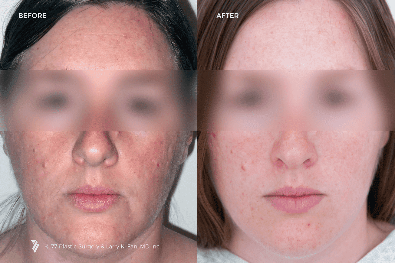77plastic-Laser-Skin-Resurfacing-1.png