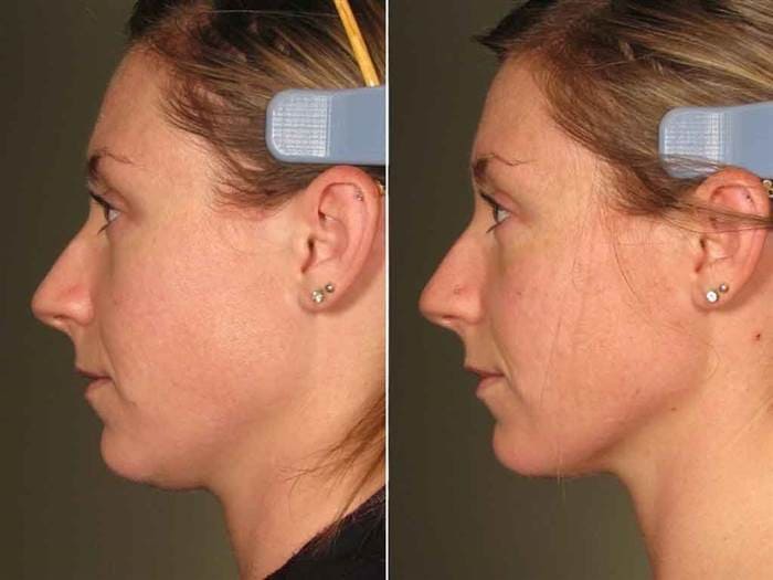 77plastic-ultherapy-before-after-face-neck-today-inline-large_95b3829691640091a7085a1a8e737409.today-inline-large.jpg