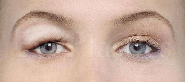 Eyelid_Pseudoptosis.jpg