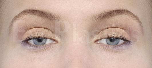 Eyelid_Ptosis.jpg