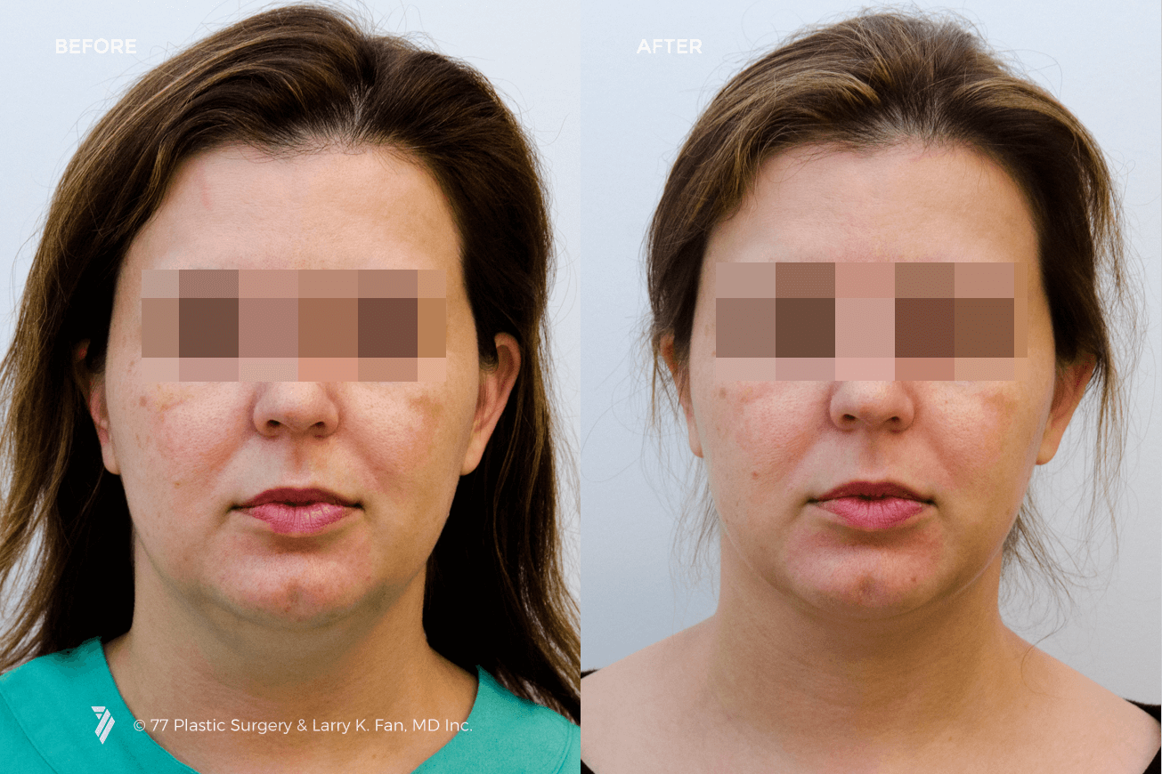 Neck-liposuction-before-and-after.png