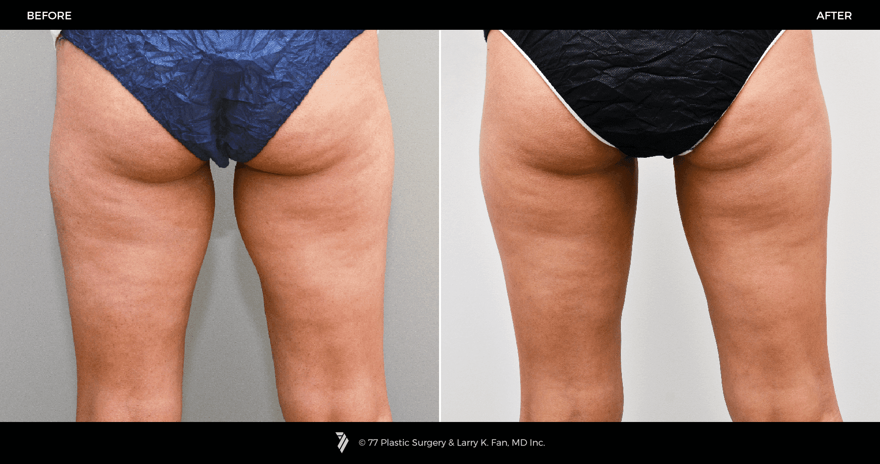 CoolSculpting-30009-2