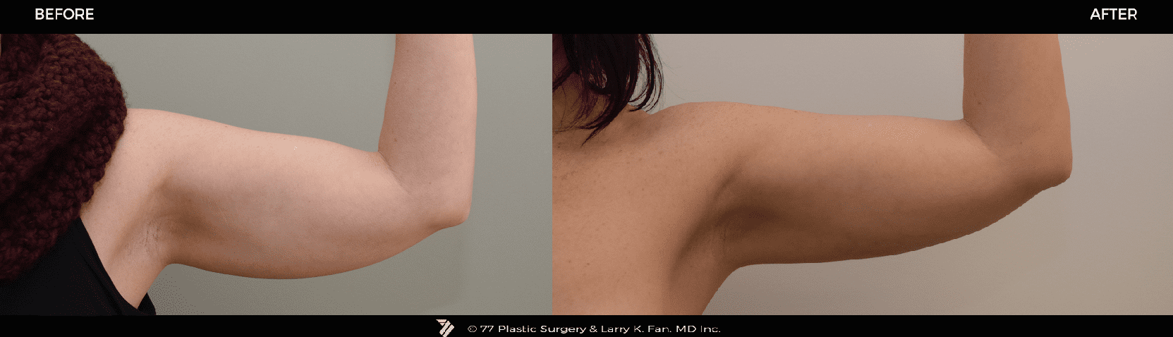 arms-coolsculpting