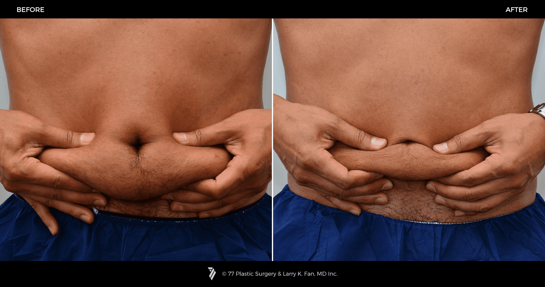 CoolSculpting-before-and-after