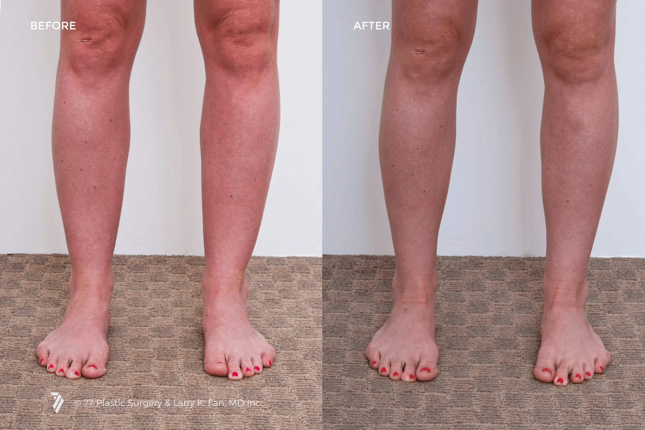ankle-liposuction-before-and-after.png