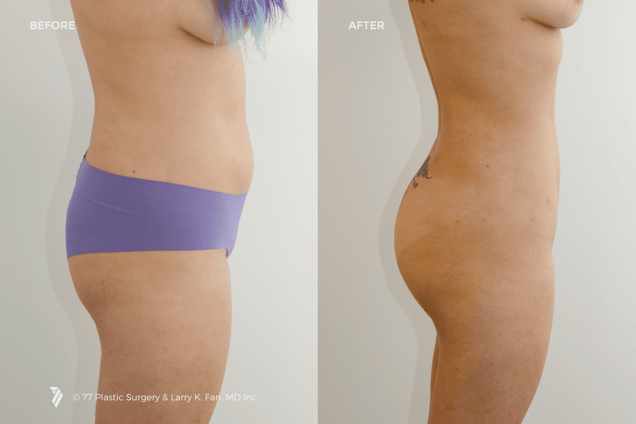 butt-liposuction-before-and-after-photos.png