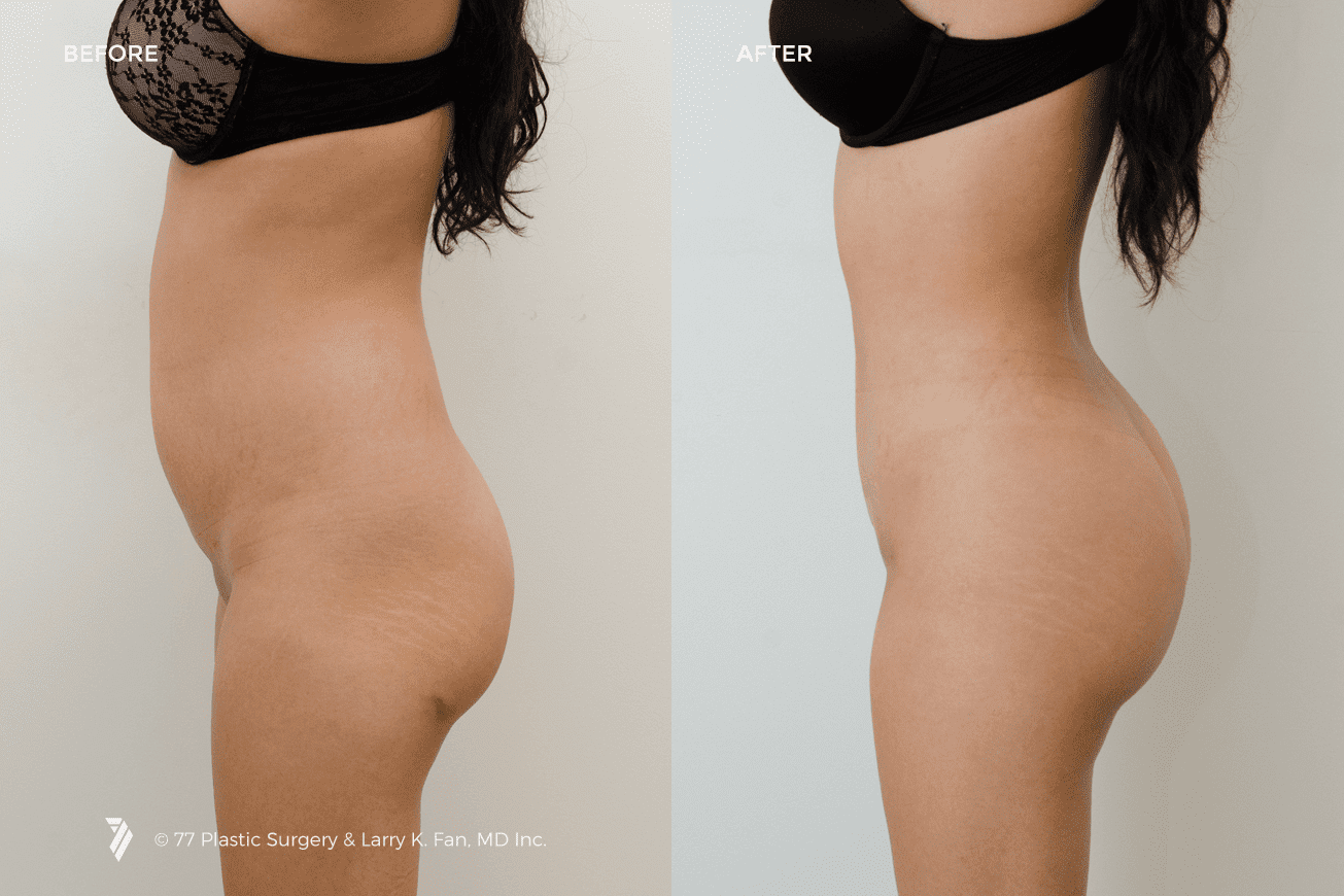 Liposuction-before-and-after.png