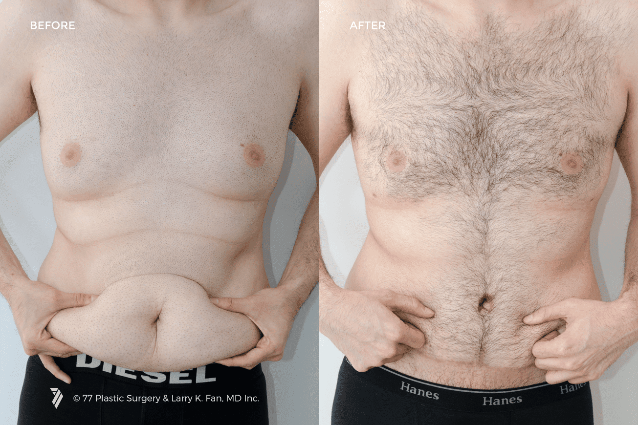 tummy-tuck-before-and-after-results-for-men-photos