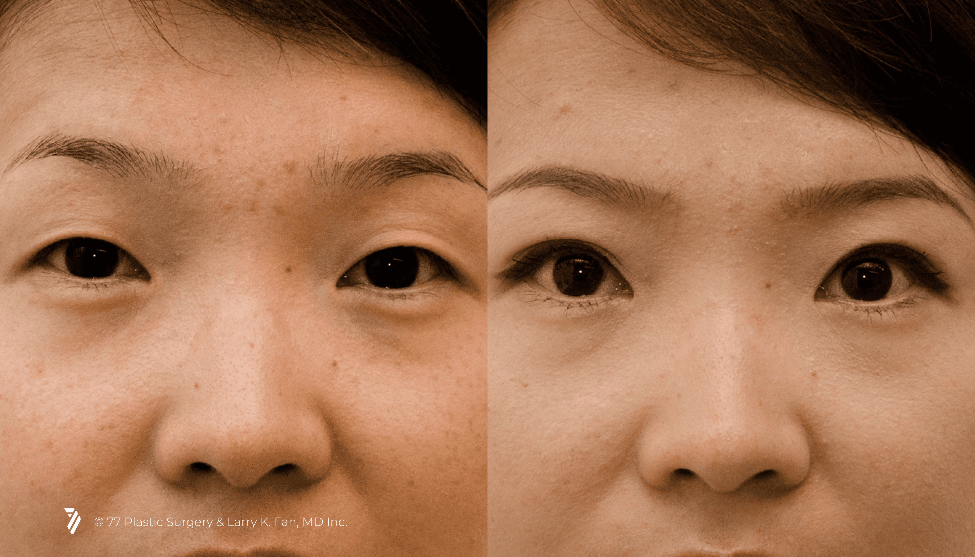 before and after of Asian Eyelid Surgery patient