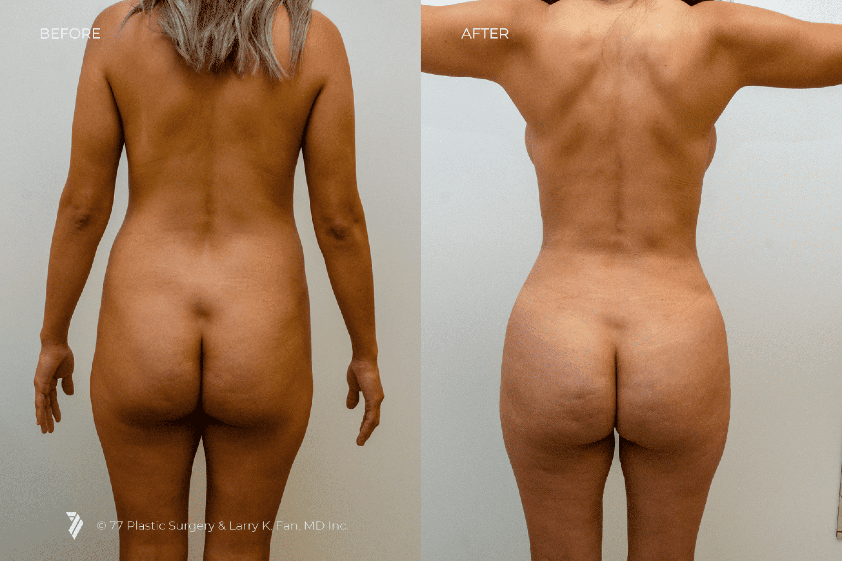 before and after of Butt Augmentation patient