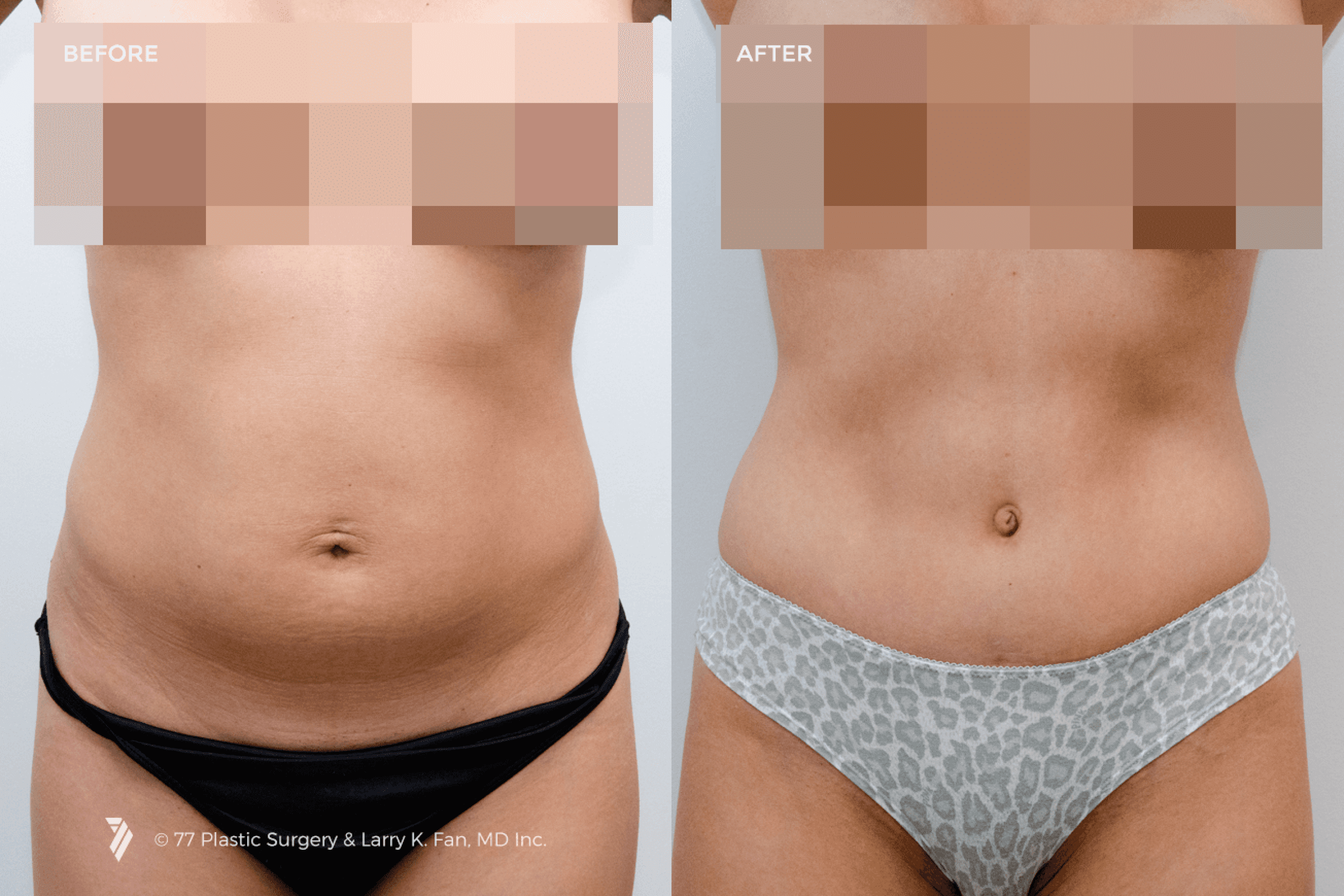 before and after procedure comparison