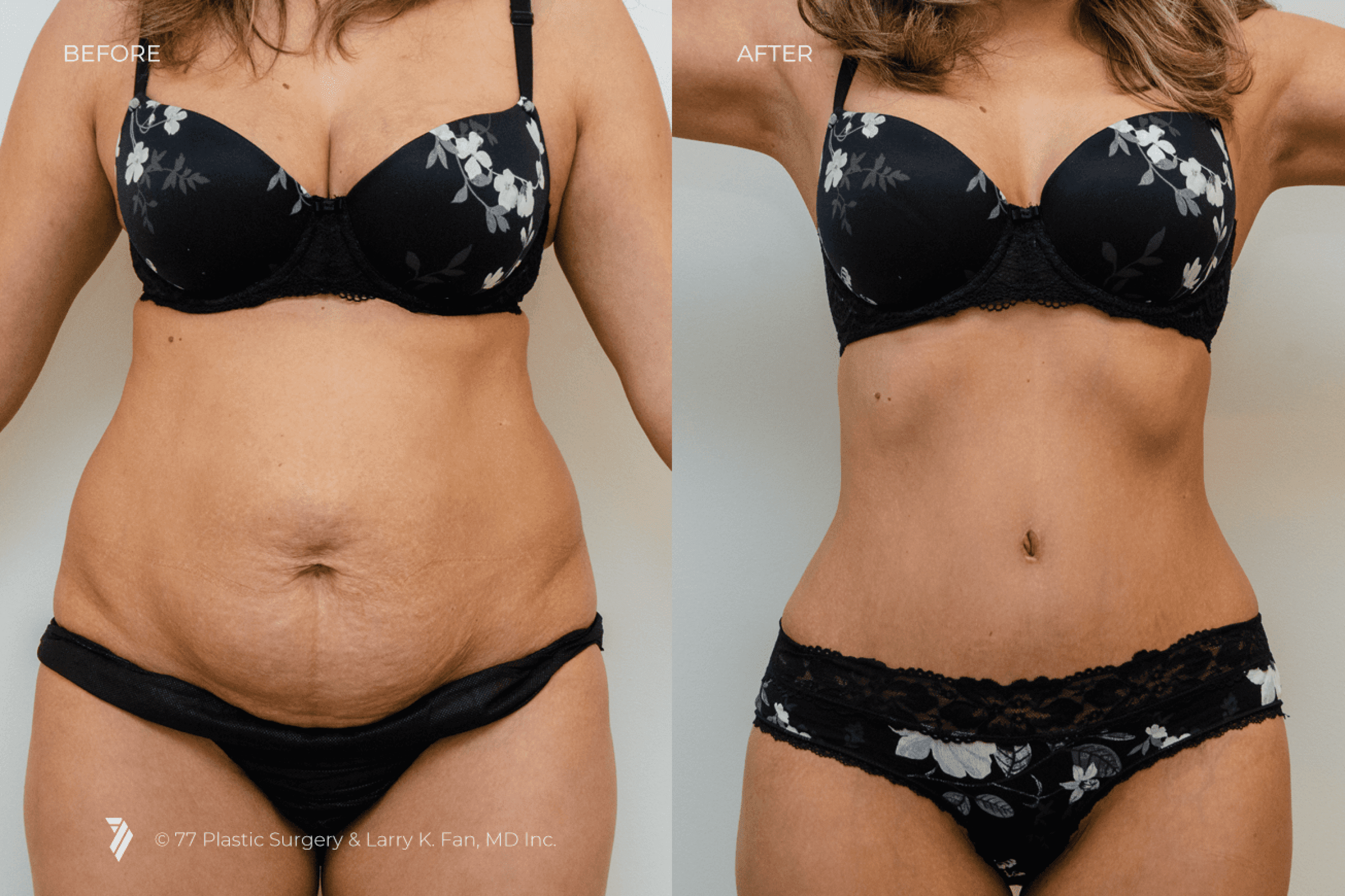 before and after of Tummy Tuck patient