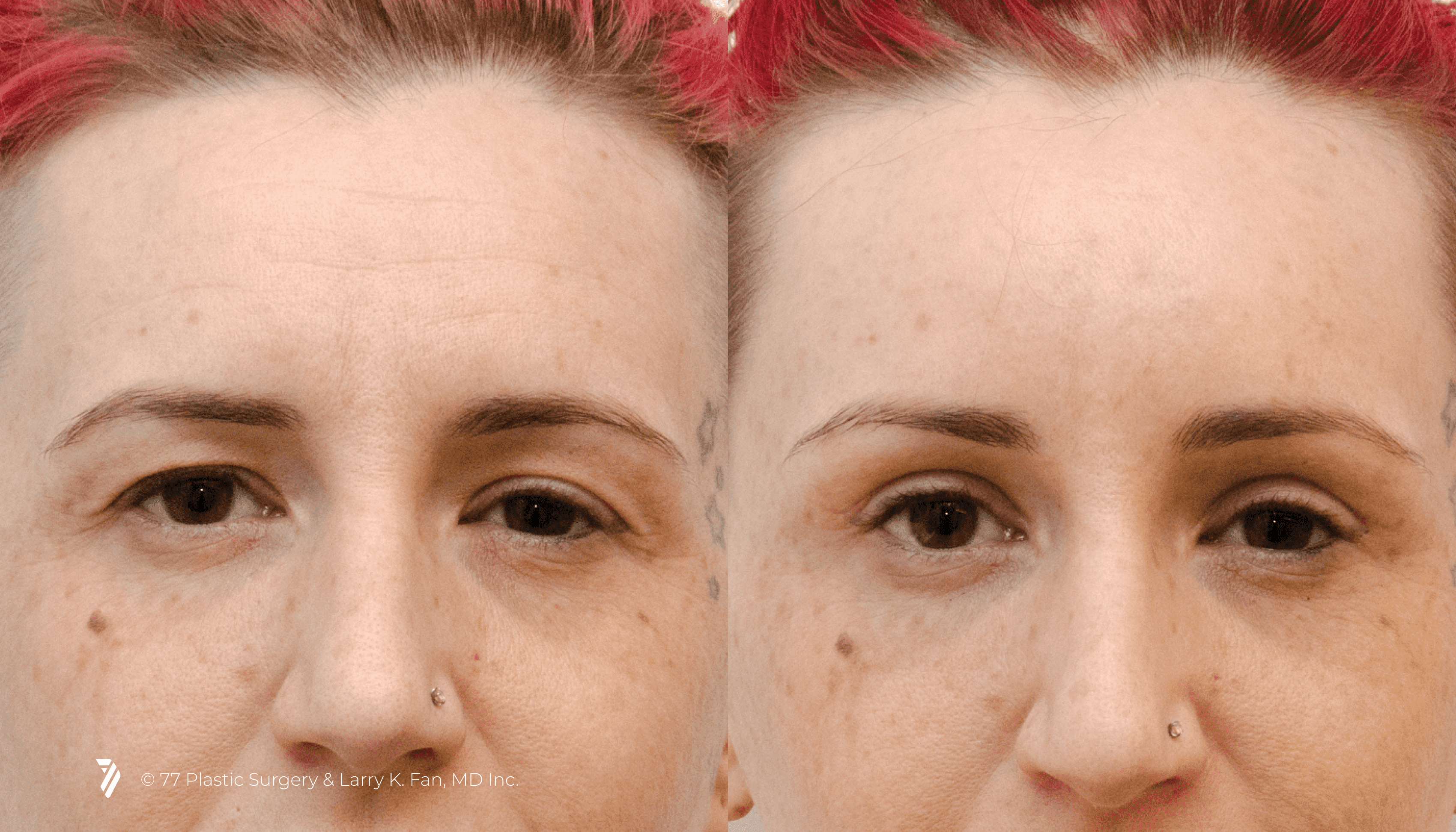 before and after procedure comparison