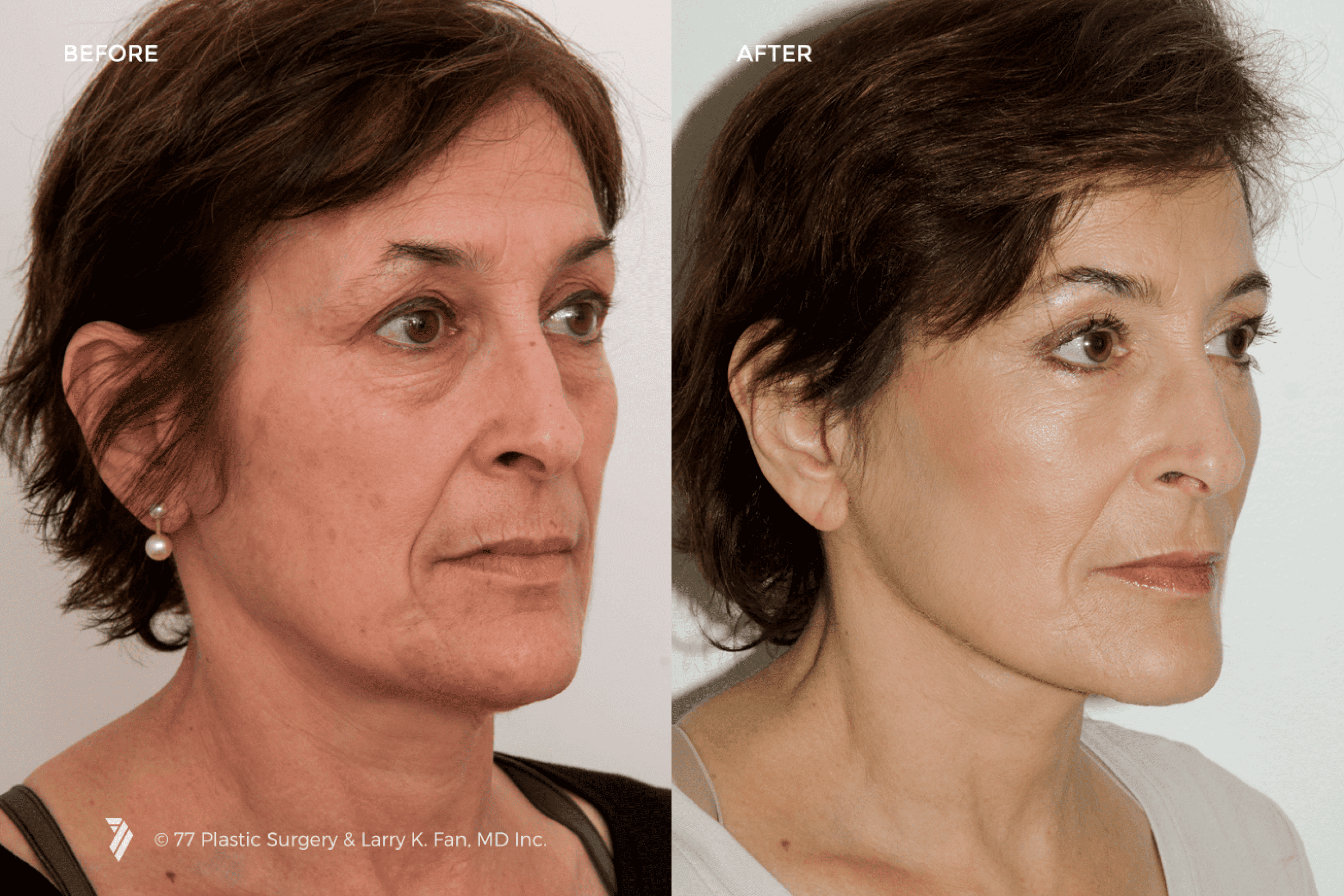 before and after of Facelift Surgery patient