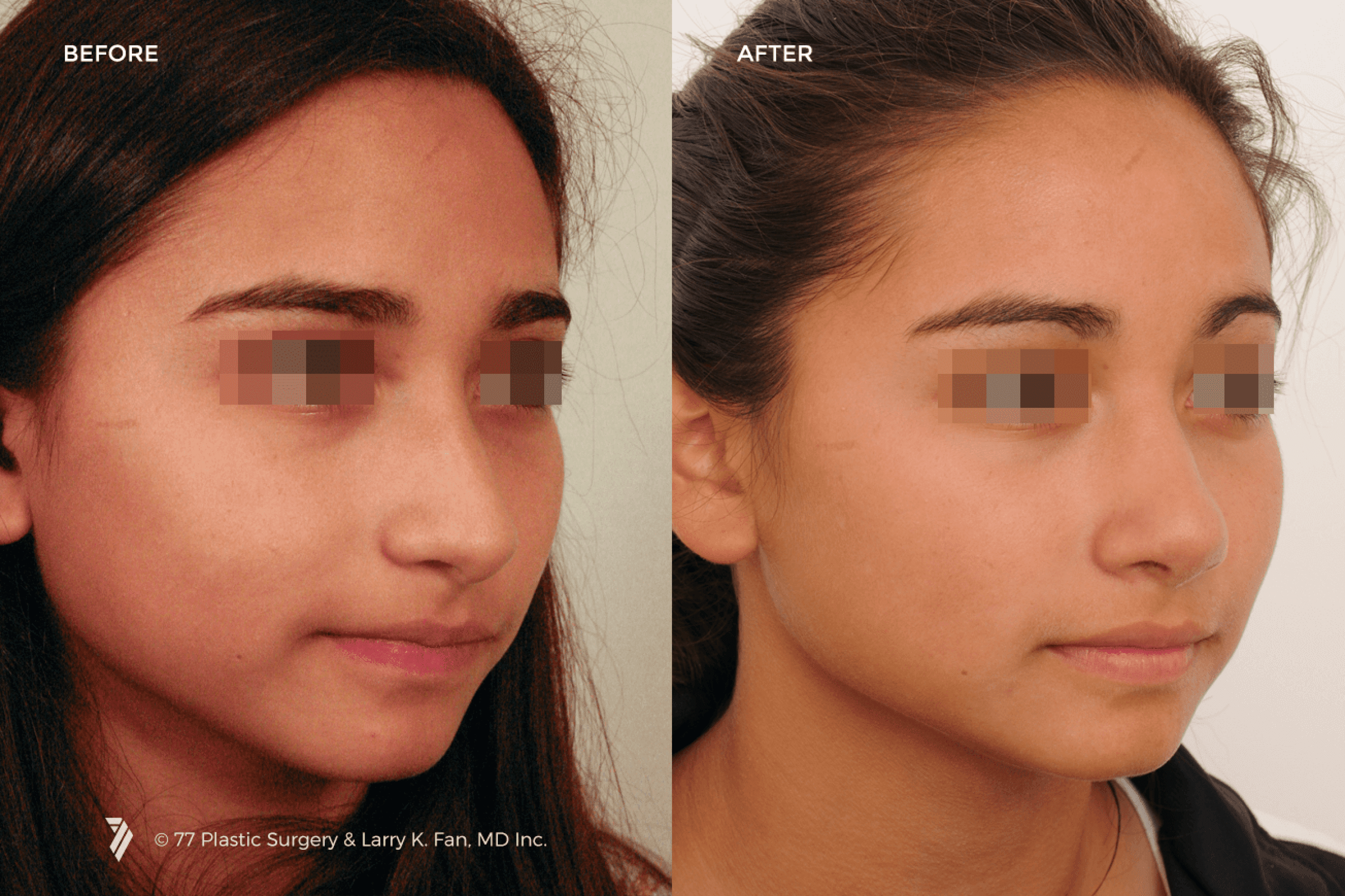 before and after of Nose Reshaping (Rhinoplasty) patient