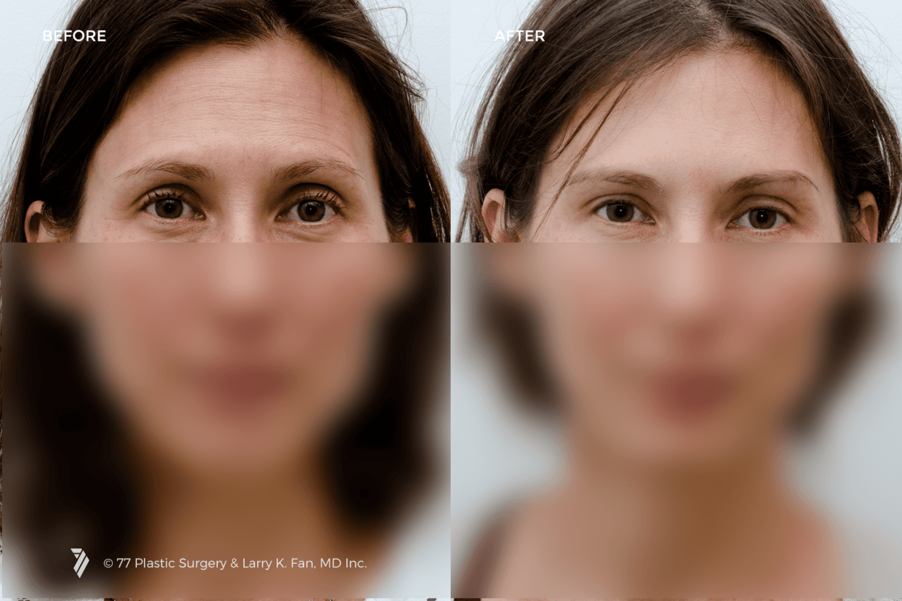 before and after of BOTOX® patient