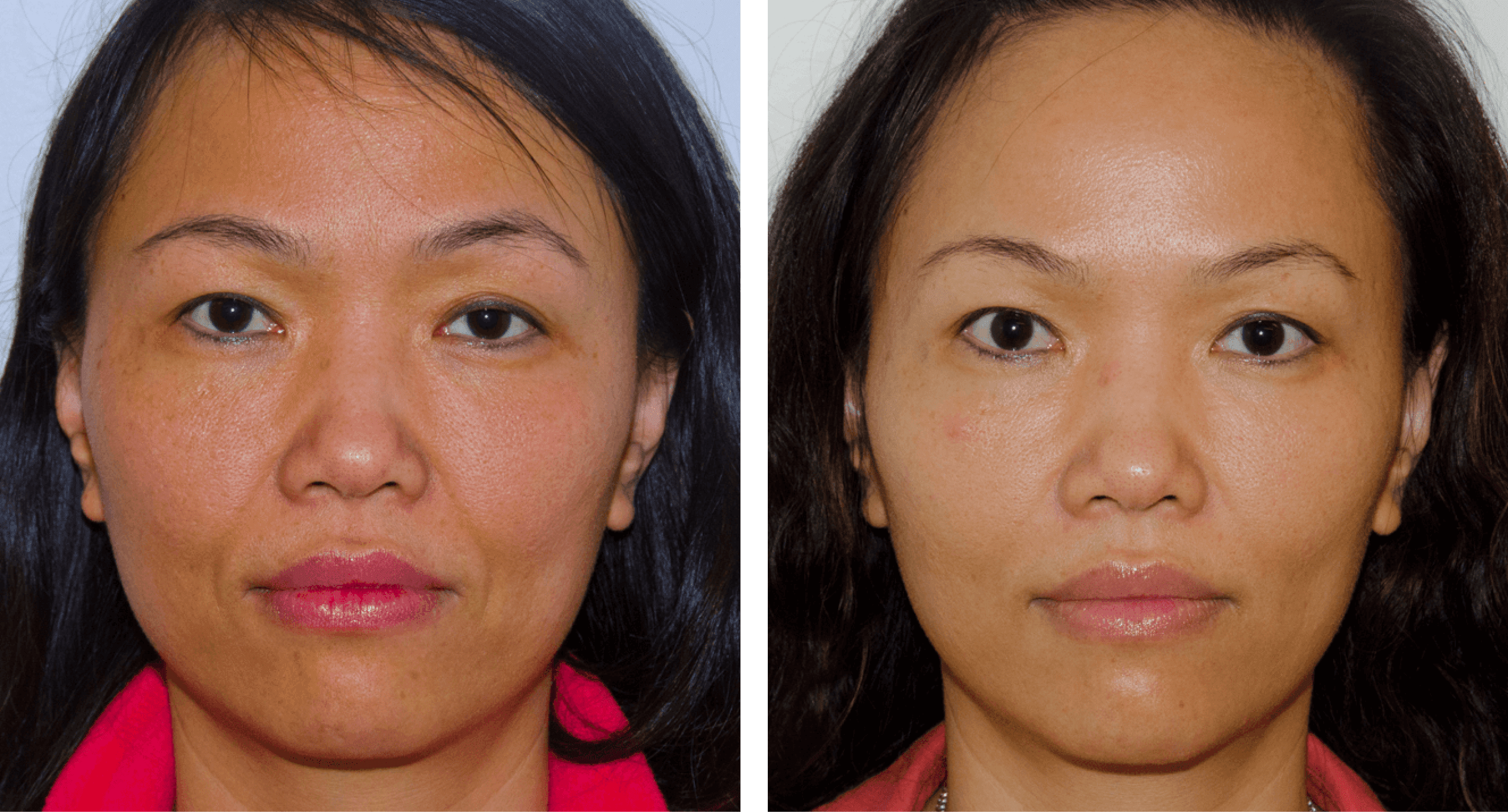 BOTOX® Photo Gallery | 77 Plastic Surgery in San Francisco
