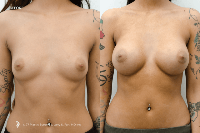 77-Plastic-Surgery_Breast-Implants-before-and-after-1.png