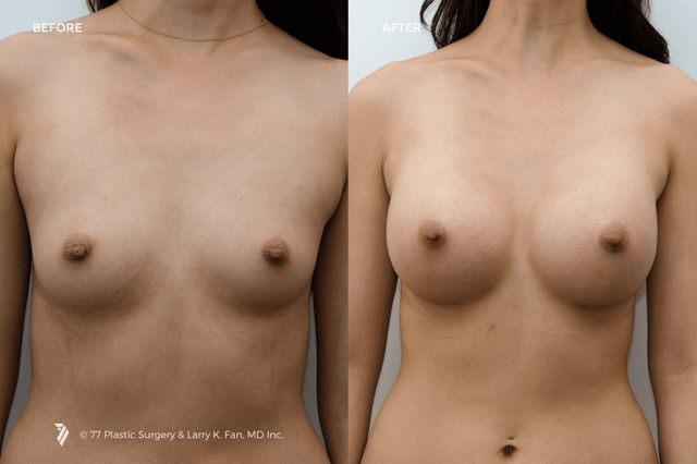 77-Plastic-Surgery_breast-implants-before-and-after_2.png