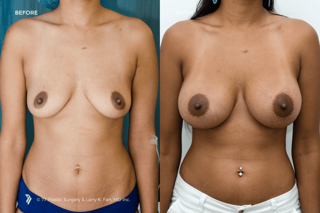 77-Plastic-Surgery_breast-implants-before-and-after_4.png