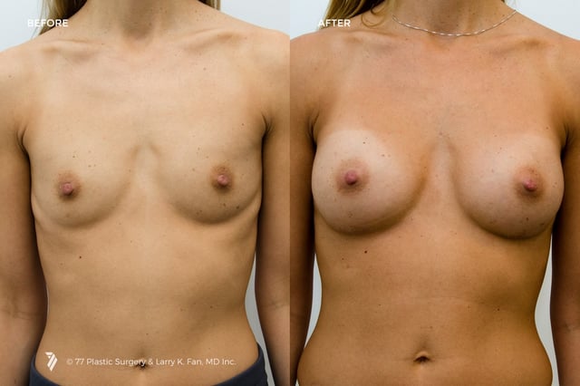77-Plastic-Surgery_breast-implants-before-and-after_5.jpg
