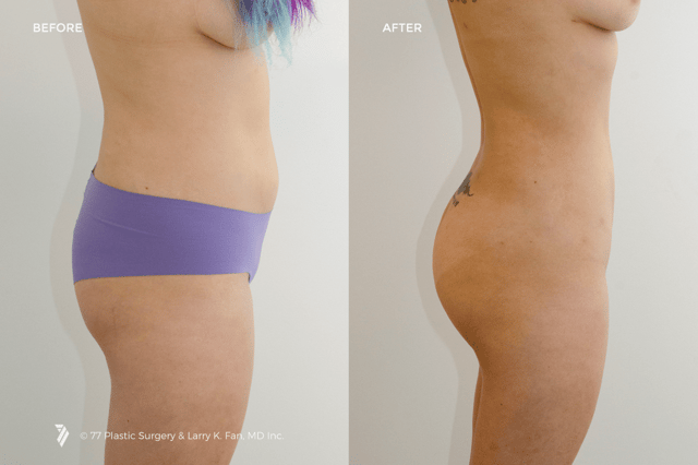 5 Liposuction Before-and-After Stories (And How to Get the Same Results)