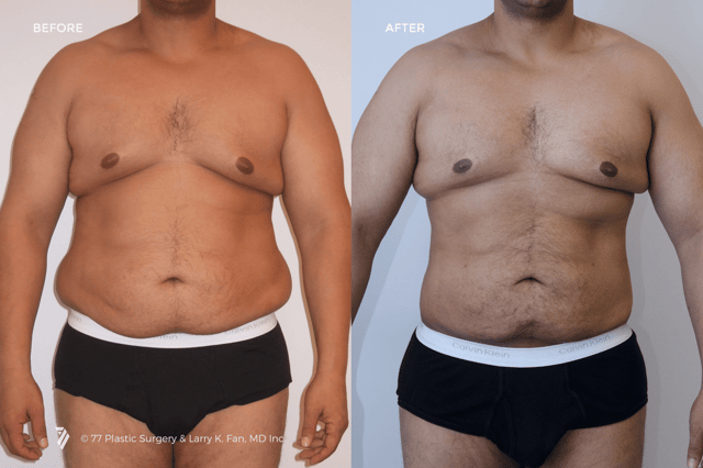 Liposuction of the abdomen and flanks, Plastic Surgeon San Francisco