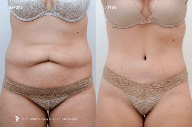 How to Use Smart Tummy Tuck Financing Options to Finally Get the