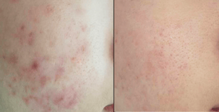 Scarlet SRF Before and after acne scars