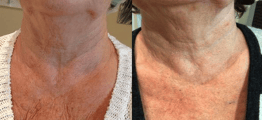 Scarlet SRF Before and after chest