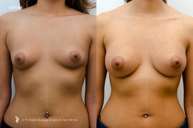 22001_Breast-Augmentation_1.png