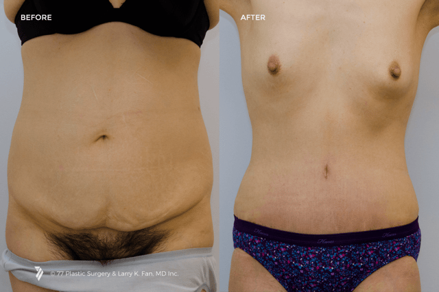 Liposuction of the Muffin Top Waistline Deformity - Explore Plastic Surgery