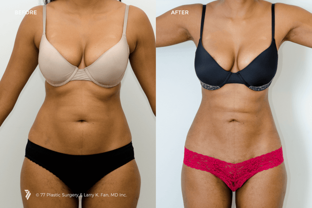 Three ways to address back rolls and bra rolls - San Francisco Bay Area  Plastic Surgery