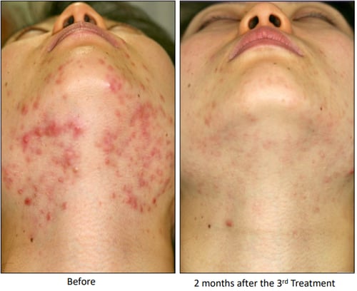 agnes-before-after-acne