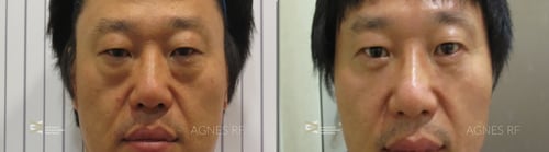 agnes-before-after-lower-eye