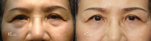 agnes-before-after-lower-eye2