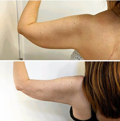 j plasma renuvion arms before and after