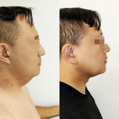 j plasma renuvion neck before and after