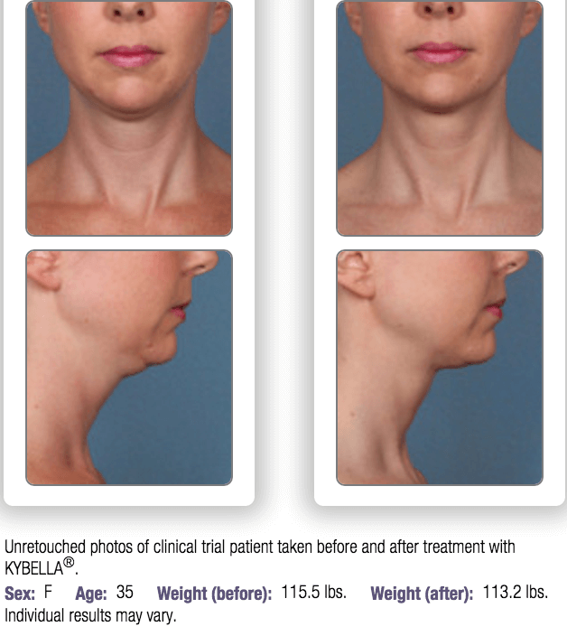 Kybella.Before_After.1_1