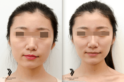asian-before-after-jawreduction_1_1.png
