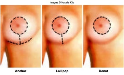 breast-lift-scars.jpg
