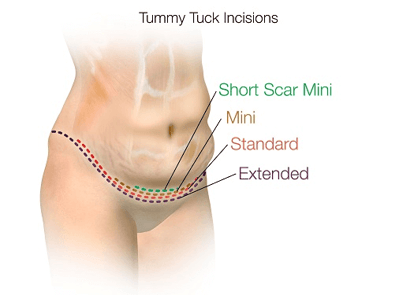 Tummy-Tuck-3.png