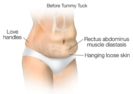 Tummy-Tuck-image1