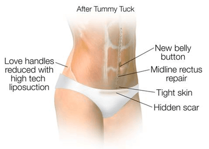 Tummy-Tuck-image2-1.png