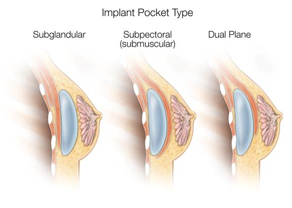 77Plastic-Surgery-Implants-Breast-Augmentation