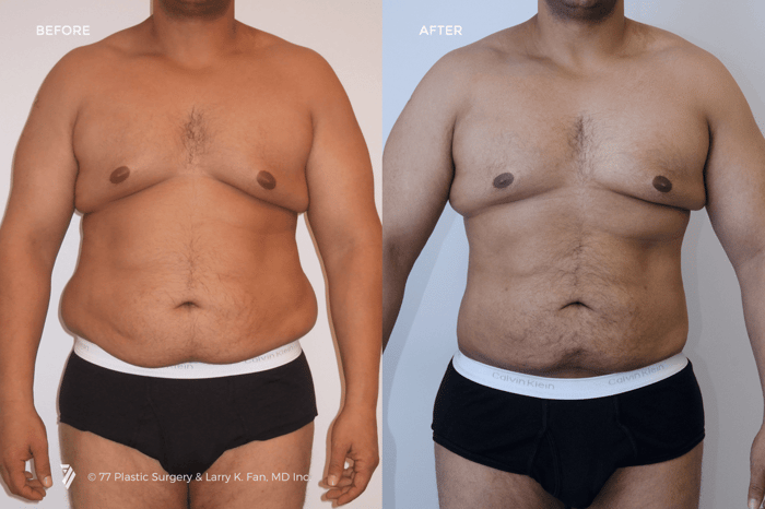 liposuction-results-before-and-after-photos-men