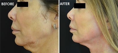Scarlet SRF Before and after neck side