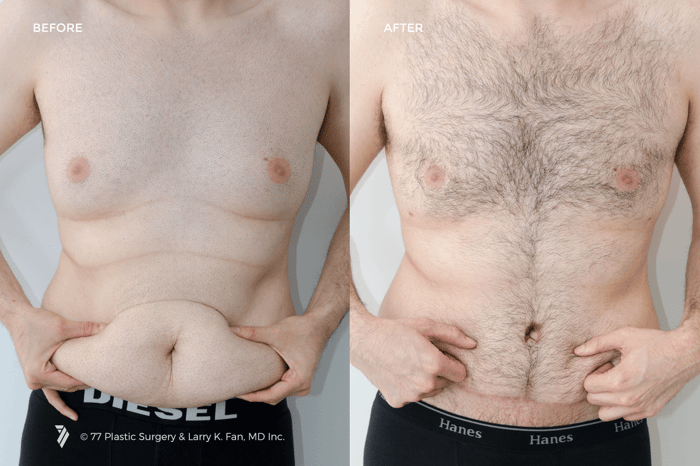 tummy-tuck-before-and-after-results-for-men-photos