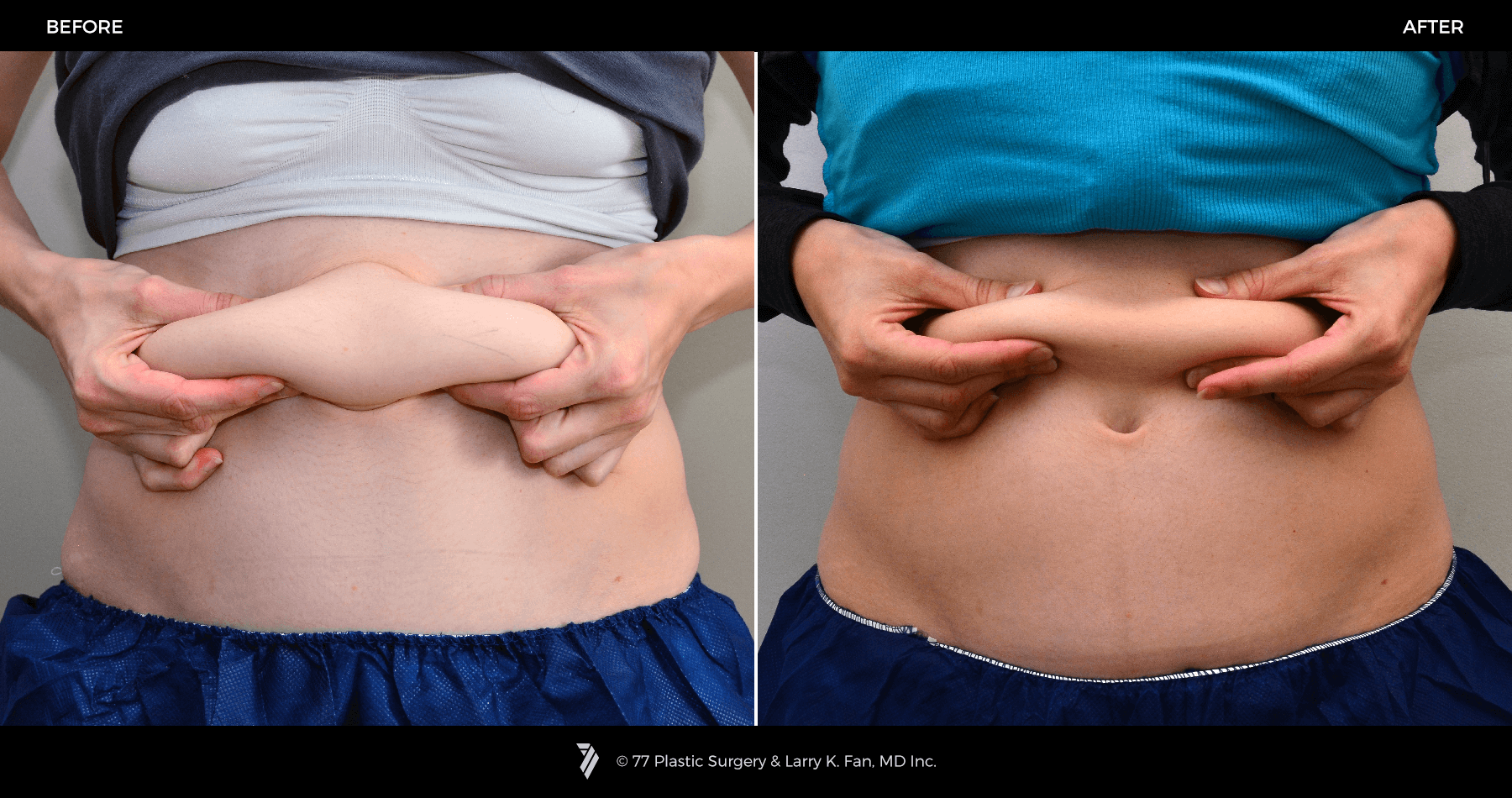 Coolsculpting-before-and-after